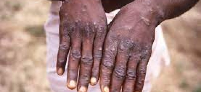 Health Ministry issue guidelines after first monkeypox case confirmed in Kerala Health Ministry issue guidelines after first monkeypox case confirmed in Kerala