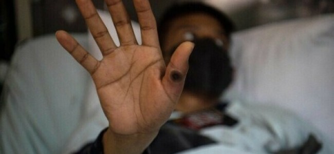 Philippines detects first mpox case this year, yet to determine strain Philippines detects first mpox case this year, yet to determine strain